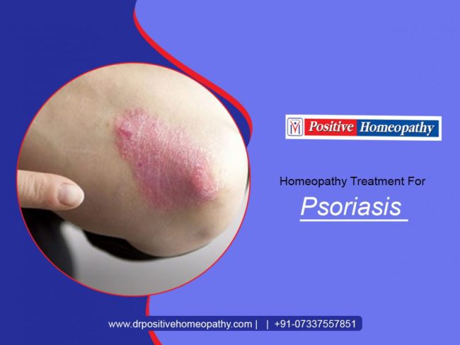 Psoriasis