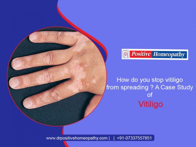 vitiligo