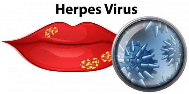 Best Homeopathy Treatment for Herpes
