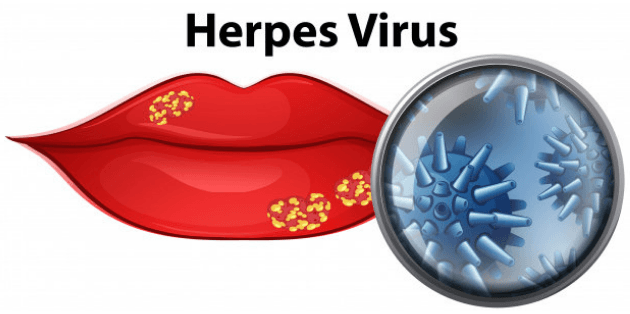 Best Homeopathy Treatment for Herpes Dr Positive Homeopathy