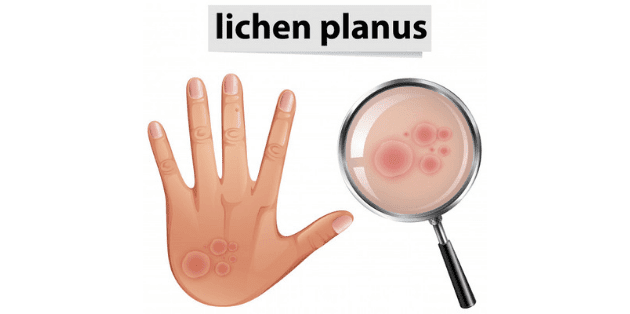 homeopathy treatment for lichen planus