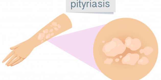 homeopathy medicine for pityriasis alba