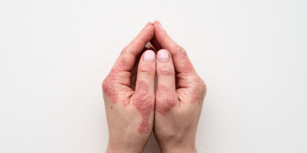 Homeopathy Treatments For Psoriasis