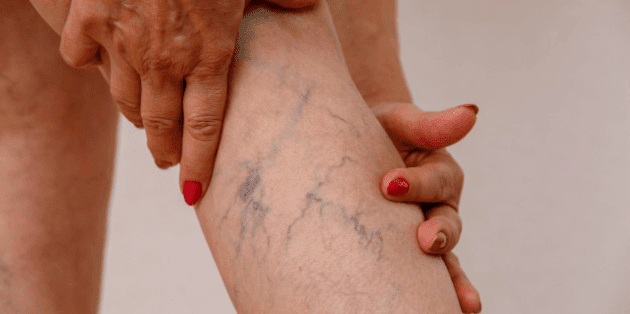 homeopathy medicine for varicose veins