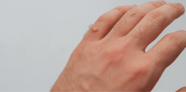 Homeopathy Treatment for Warts