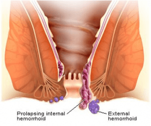 homeopathy medicine of piles