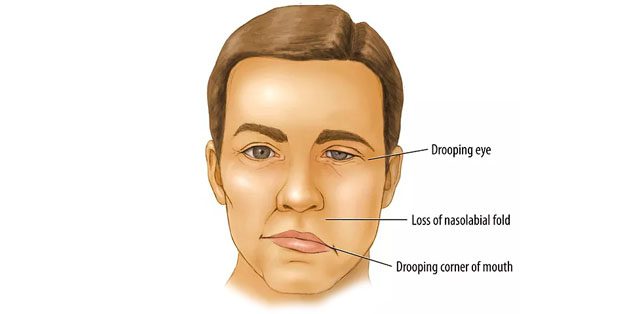  homeopathy treatment for bell's palsy