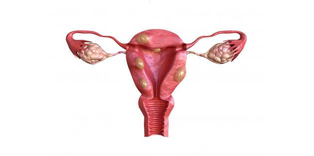 Best Homeopathy Treatment for Fibroids