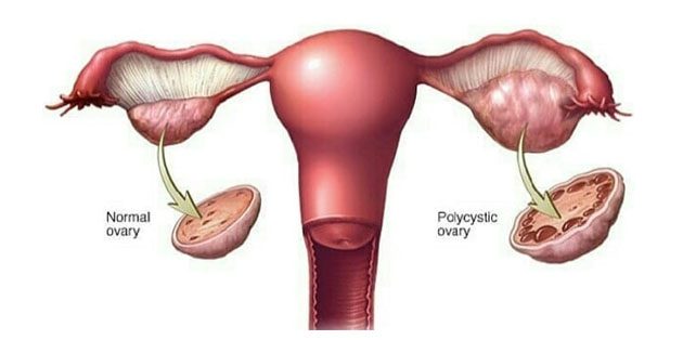 PCOS Medicine In Homeopathy