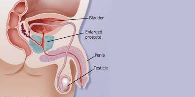 Understanding Enlarged Prostate Pain Causes, Symptoms, and Relief