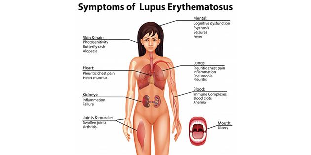 Homeopathy treatment for Systemic Lupus Erythematosus