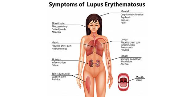 Lupus what is The Best