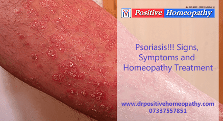 Homeopathy Medicine for Psoriasis
