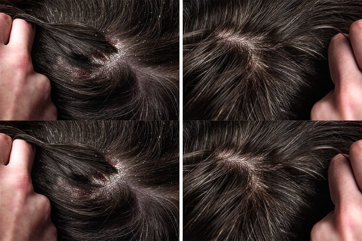 Psoriasis on-Scalp