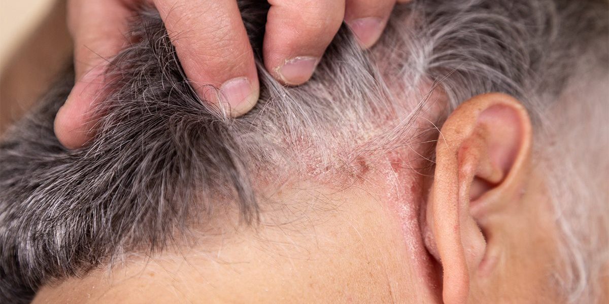 Psoriasis on Scalp Psoriasis on Scalp