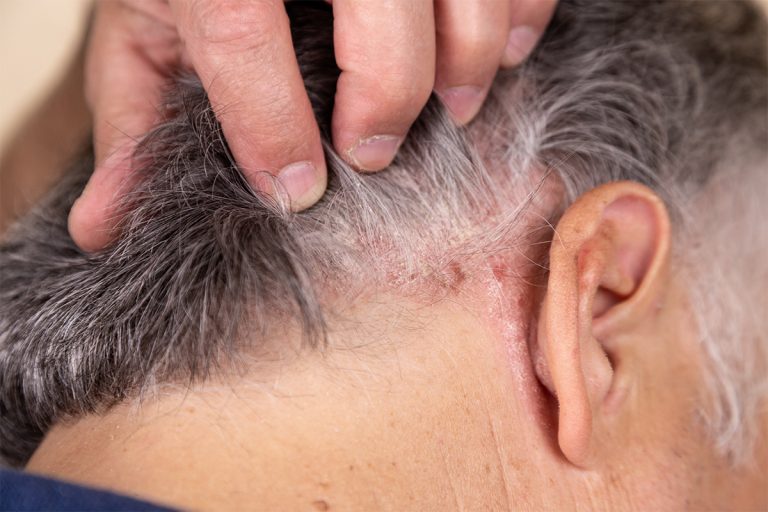 Psoriasis on Scalp