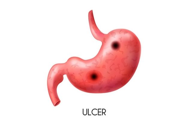 Ulcer Treatment _ Dr. Positive Homeopathy