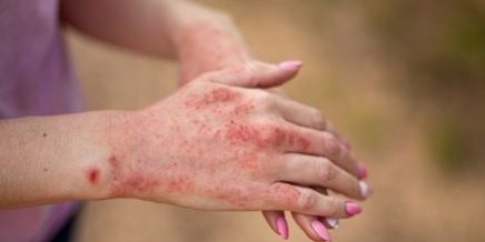 Atopic Dermatitis in Adults _ drpositivehomeopathy