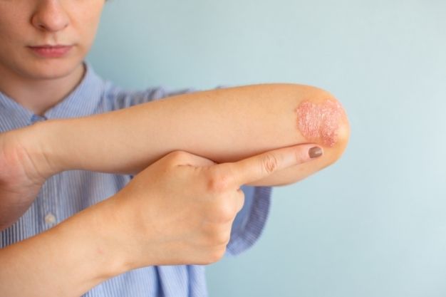 Atopic Dermatitis in Adults - drpositivehomeopathy-
